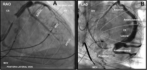 lv lead|coronary sinus pacer lead.